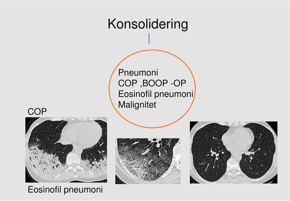 Eosinofil pneumoni