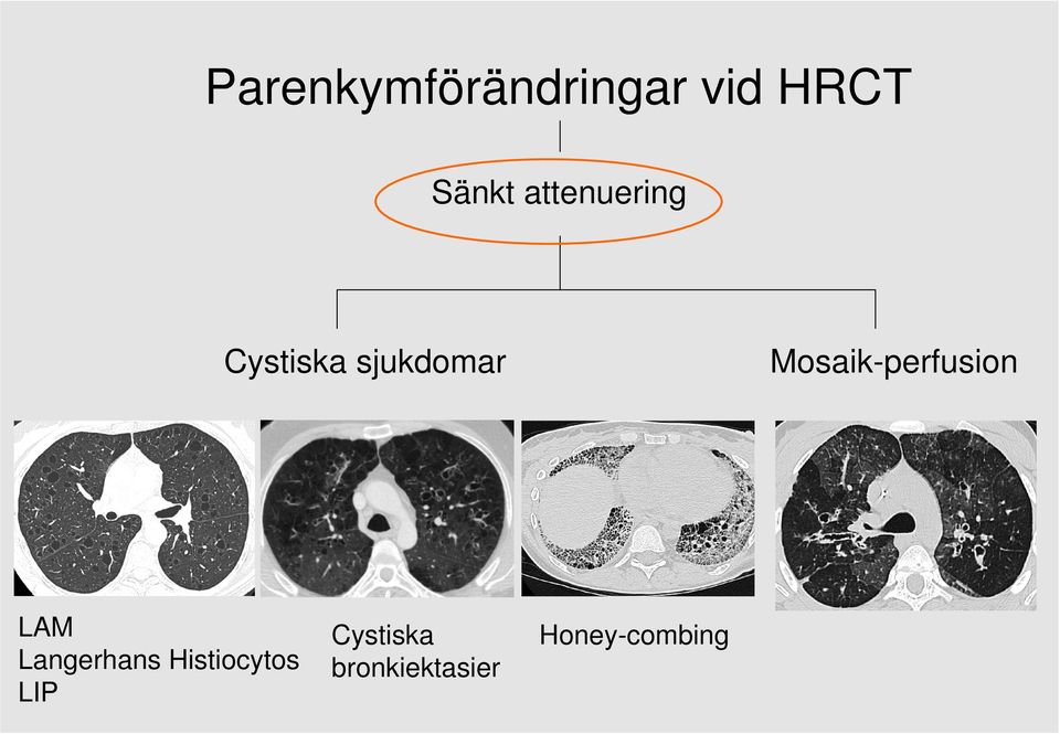 Mosaik-perfusion LAM Langerhans