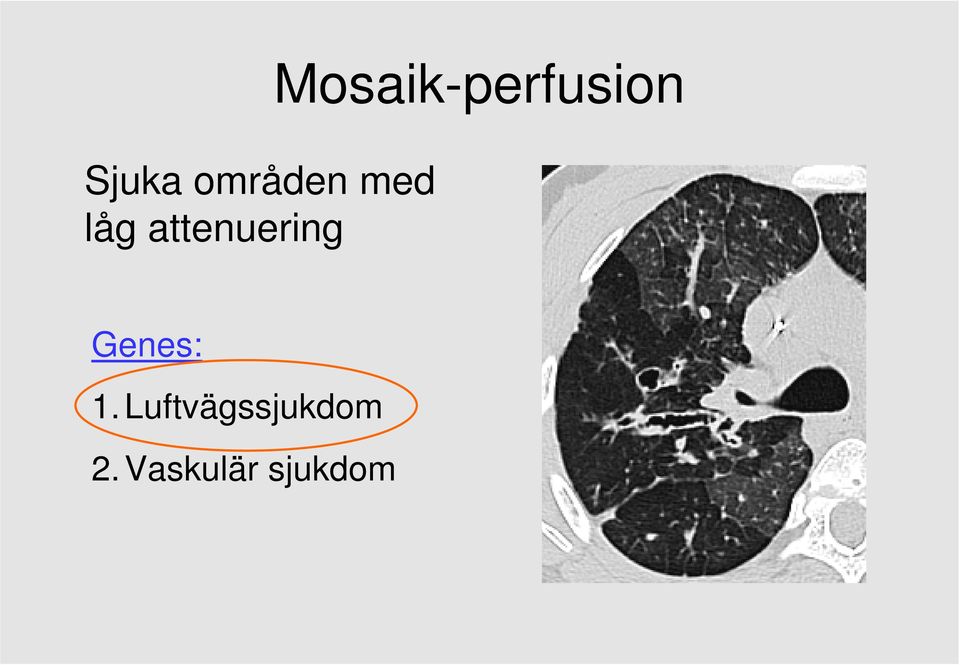 Mosaik-perfusion Genes: