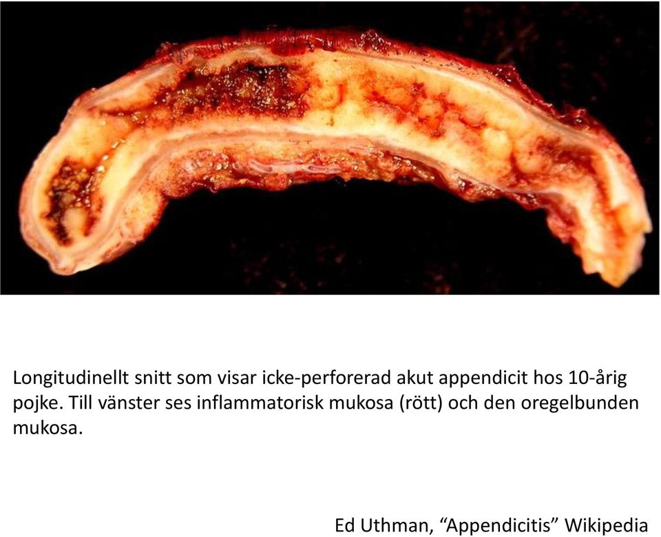 Till vänster ses inflammatorisk mukosa (rött)