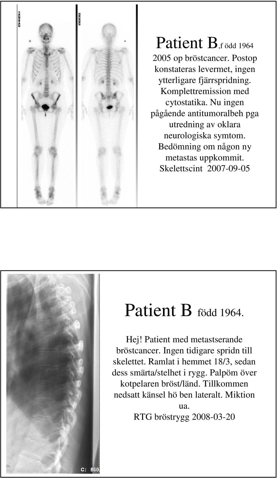 Skelettscint 2007-09-05 Patient B född 1964. Hej! Patient med metastserande bröstcancer. Ingen tidigare spridn till skelettet.