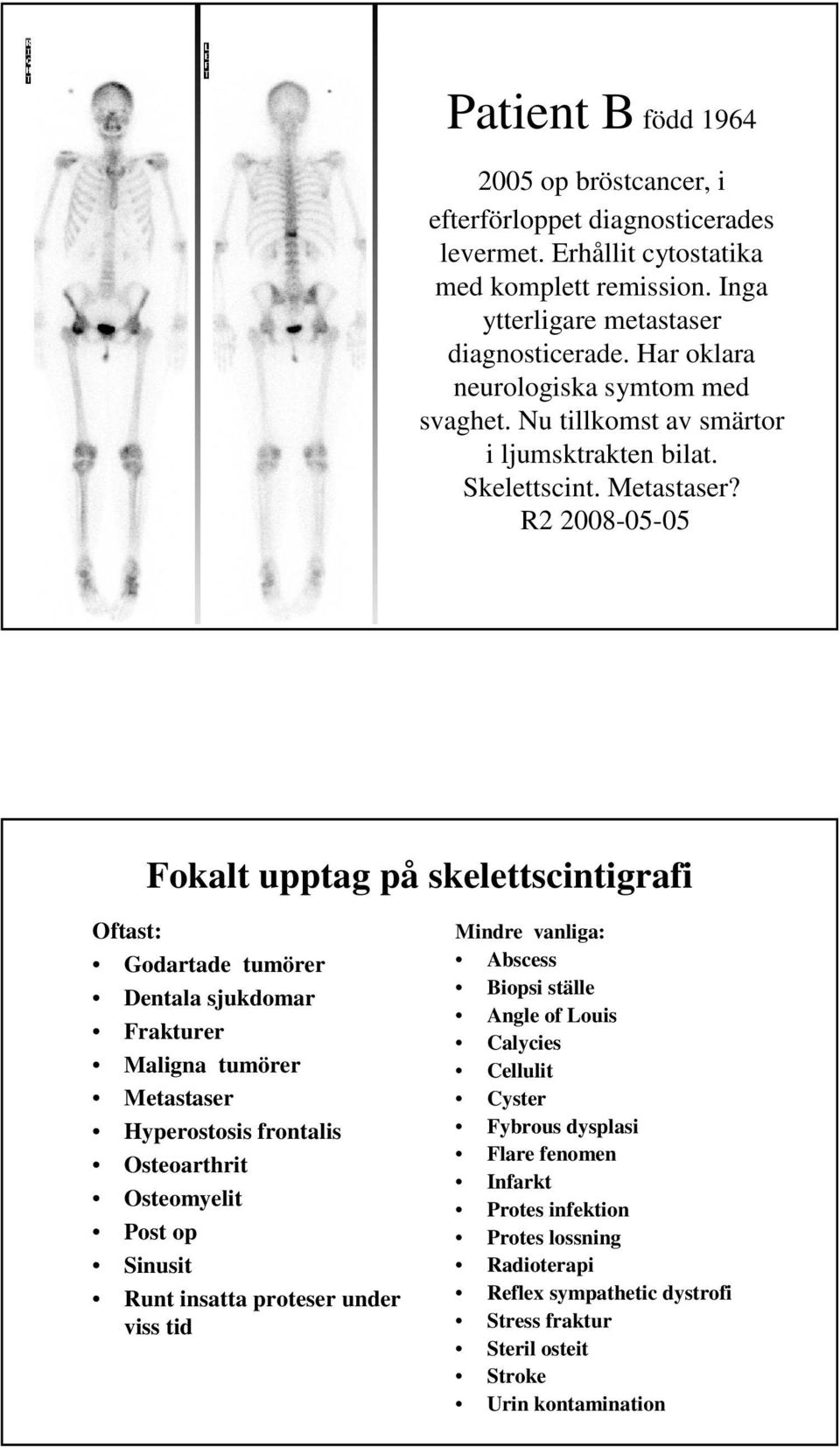 R2 2008-05-05 Fokalt upptag på skelettscintigrafi Oftast: Godartade tumörer Dentala sjukdomar Frakturer Maligna tumörer Metastaser Hyperostosis frontalis Osteoarthrit Osteomyelit Post op