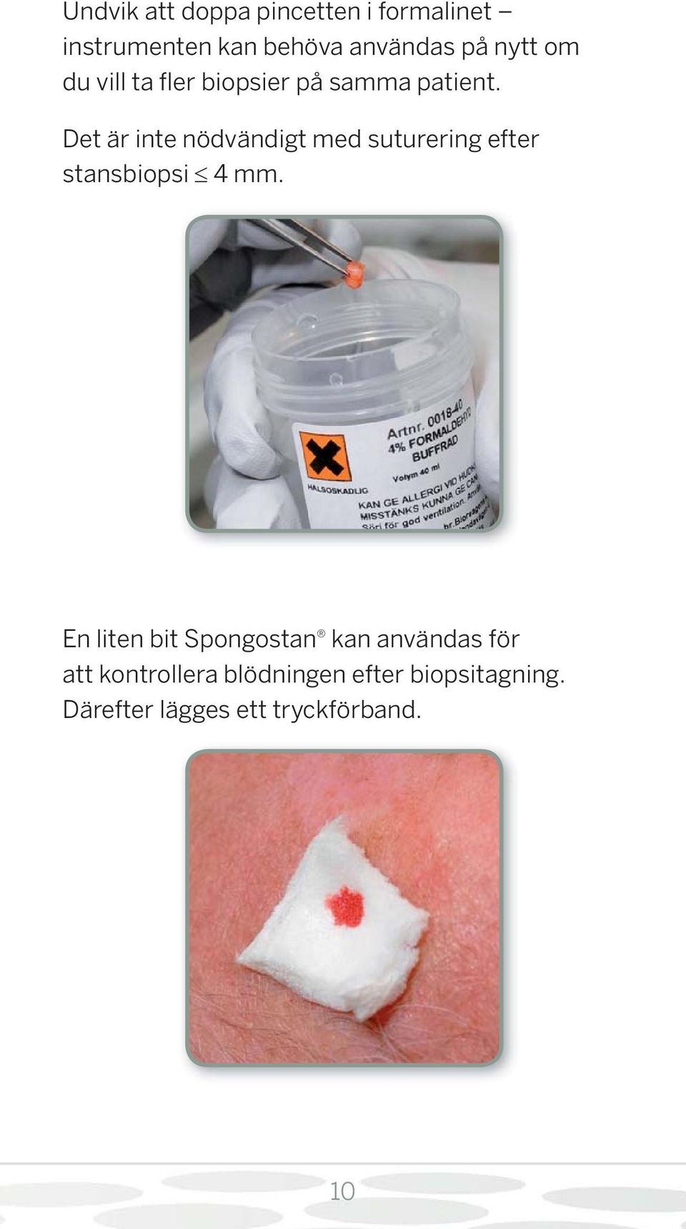 Det är inte nödvändigt med suturering efter stansbiopsi 4 mm.