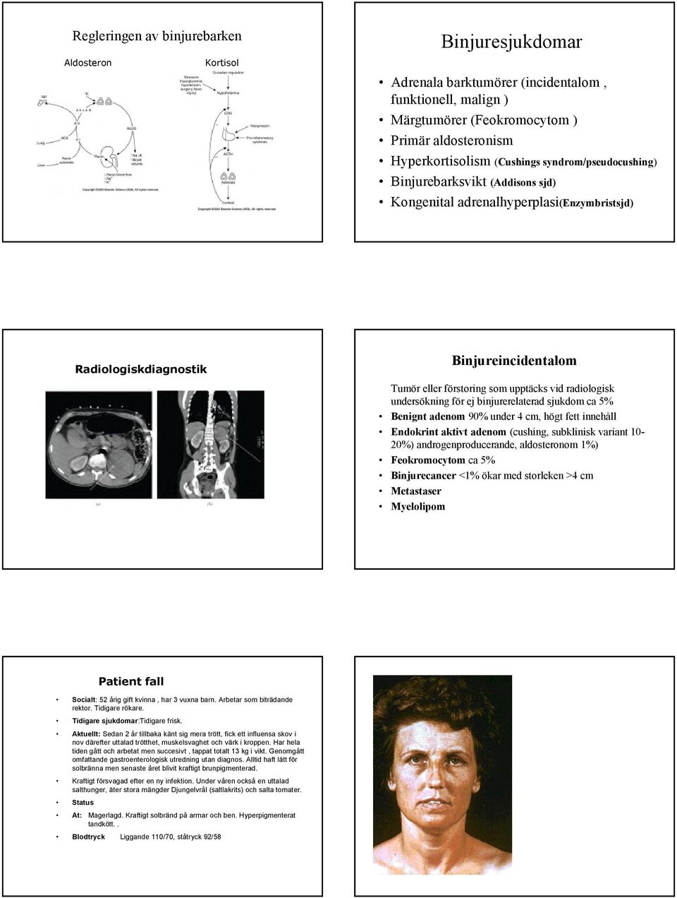 radiologisk undersökning för ej binjurerelaterad sjukdom ca 5% Benignt adenom 90% under 4 cm, högt fett innehåll Endokrint aktivt adenom (cushing, subklinisk variant 10-20%) androgenproducerande,