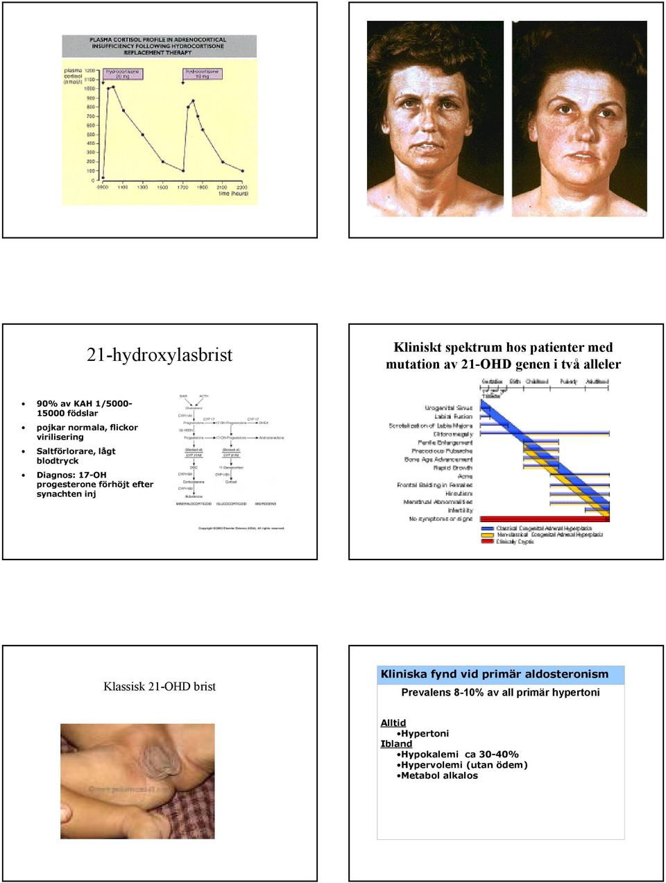 progesterone förhöjt efter synachten inj Klassisk 21-OHD brist Kliniska fynd vid primär aldosteronism