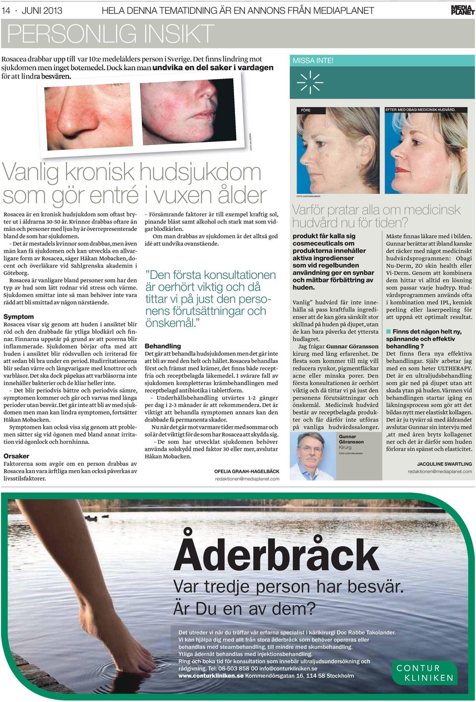 FOTO: GALDERMA Vanlig kronisk hudsjukdom som gör entré i vuxen ålder Rosacea är en kronisk hudsjukdom som oftast bryter ut i åldrarna 30-50 år.