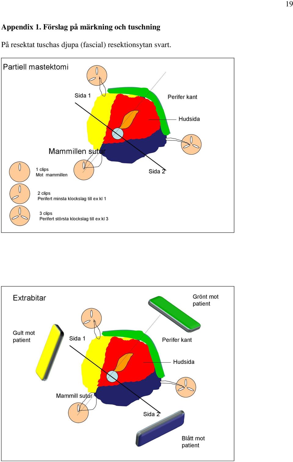 Partiell mastektomi Sida 1 Perifer kant Hudsida Mammillen sutur 1 clips Mot mammillen Sida 2 2 clips