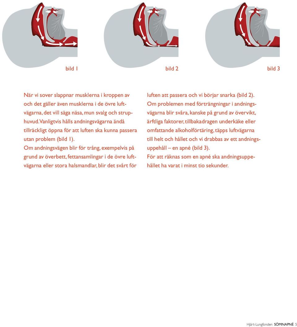 Om andningsvägen blir för trång, exempelvis på grund av överbett, fettansamlingar i de övre luftvägarna eller stora halsmandlar, blir det svårt för luften att passera och vi börjar snarka (bild 2).