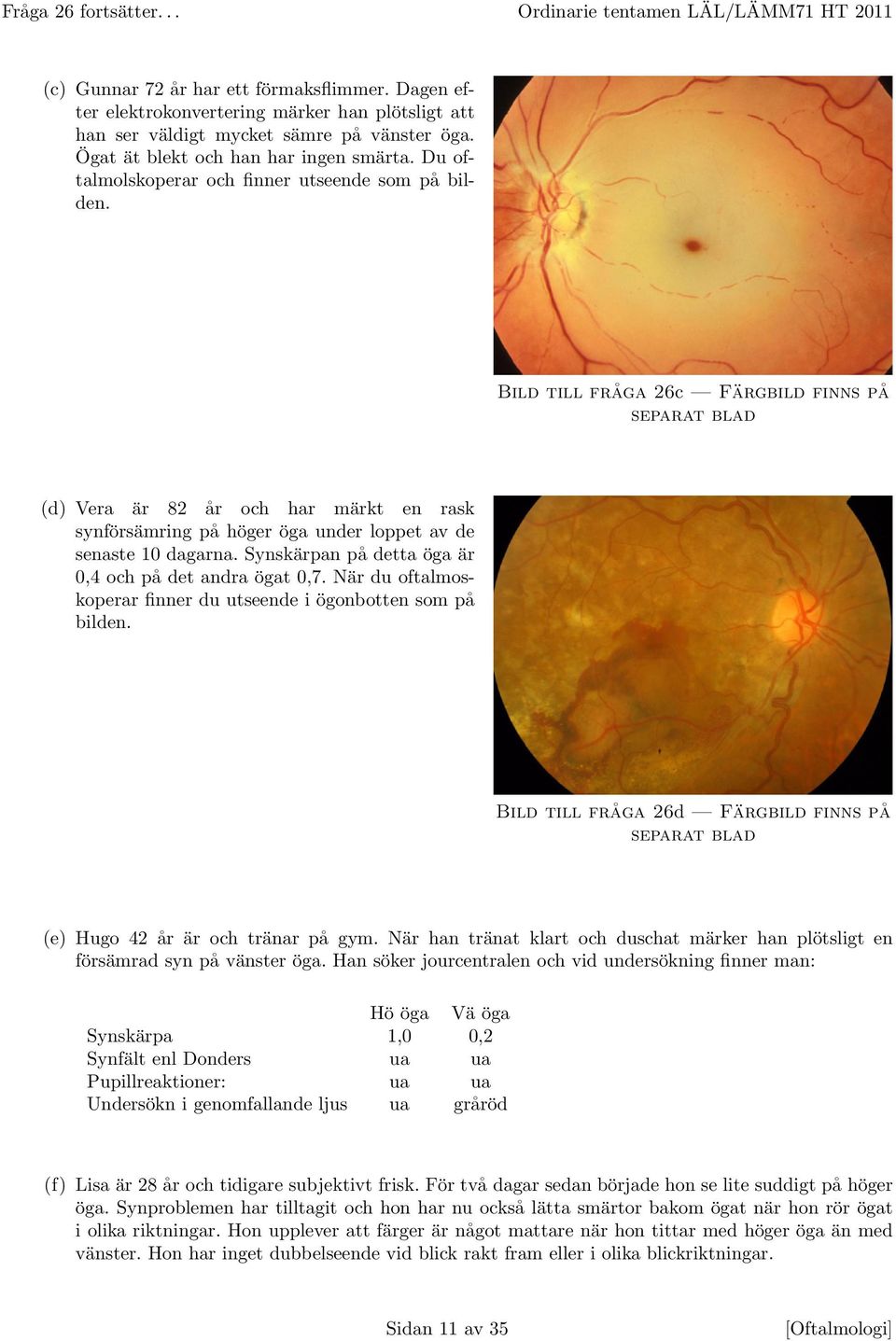 Bild till fråga 26c Färgbild finns på separat blad (d) Vera är 82 år och har märkt en rask synförsämring på höger öga under loppet av de senaste 10 dagarna.