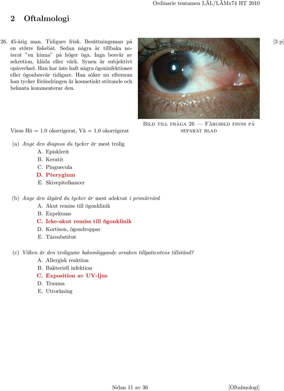 Visus Hö = 1.0 okorrigerat, Vä = 1.0 okorrigerat Bild till fråga 26 Färgbild finns på separat blad (a) Ange den diagnos du tycker är mest trolig A. Episklerit B. Keratit C. Pinguecula D. Pterygium E.