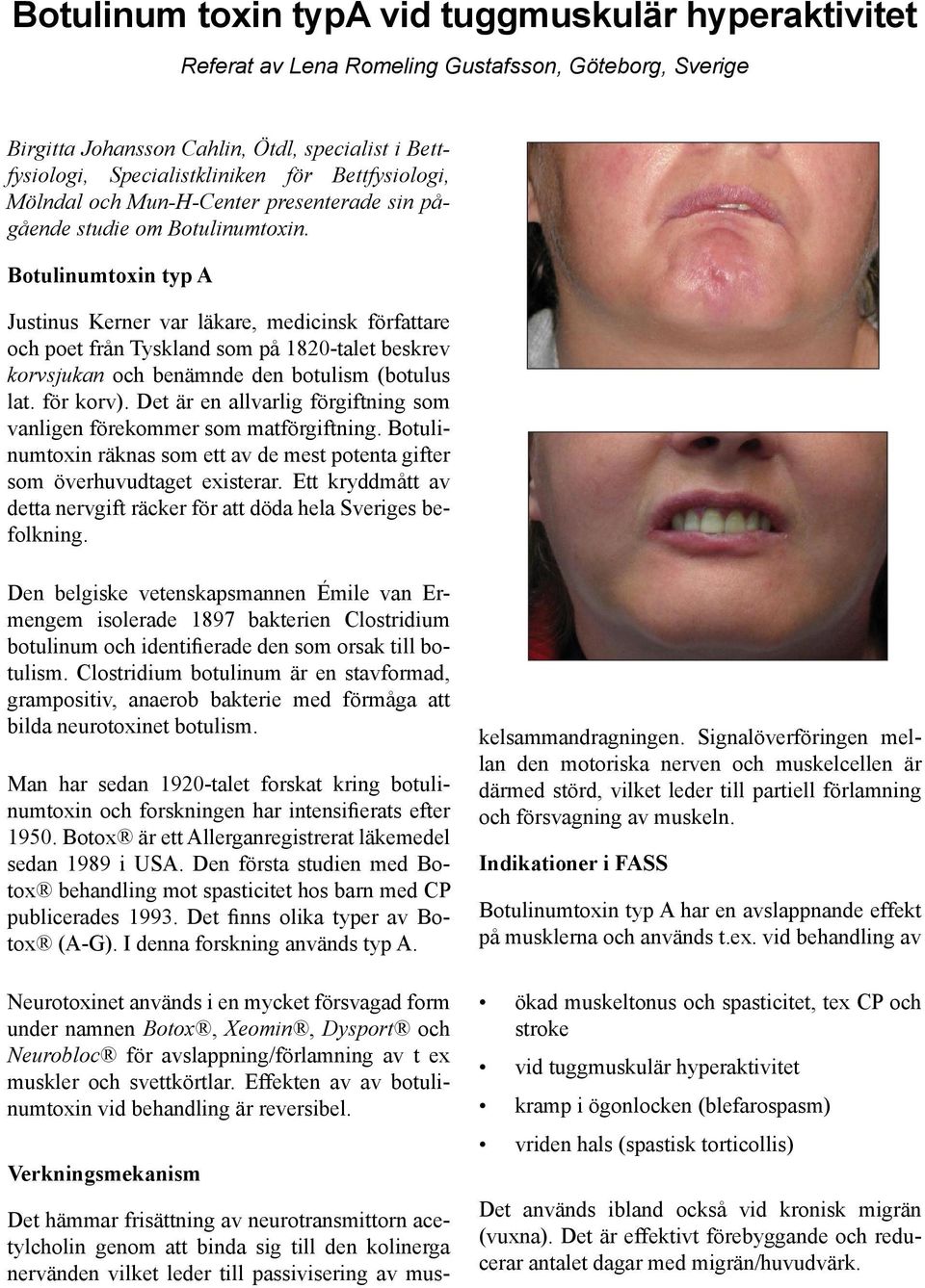 Botulinumtoxin typ A Justinus Kerner var läkare, medicinsk författare och poet från Tyskland som på 1820-talet beskrev korvsjukan och benämnde den botulism (botulus lat. för korv).