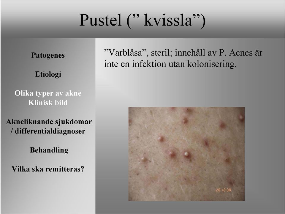 av P. Acnes är inte en