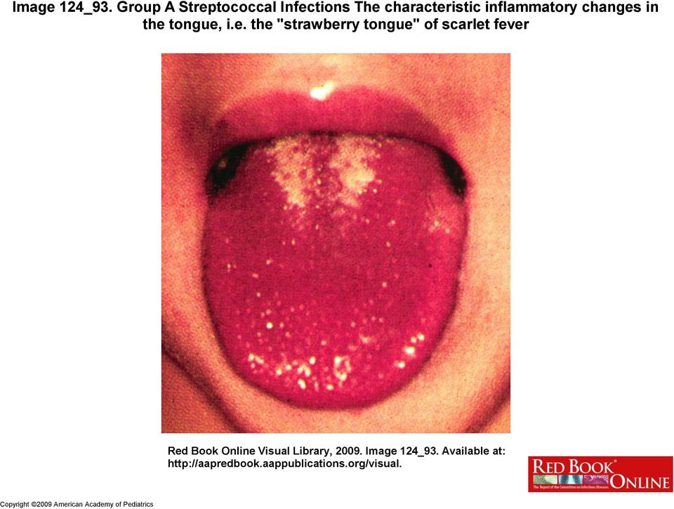 the tongue, i.e. the "strawberry tongue" of scarlet fever Red Book Online
