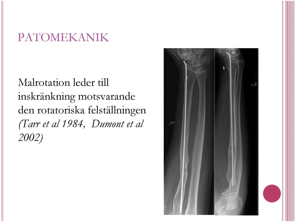 den rotatoriska felställningen