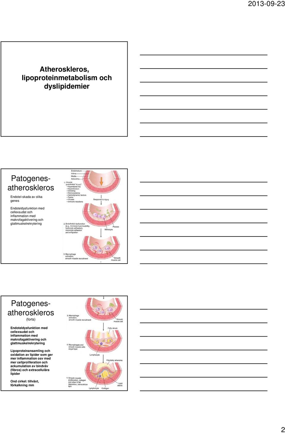 cellexsudat och inflammation med makrofagaktivering och glattmuskelrekrytering Lipoproteinansamling och oxidation av lipider som ger