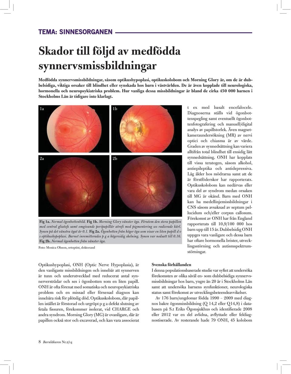 Hur vanliga dessa missbildningar är bland de cirka 450 000 barnen i Stockholms Län är tidigare inte klarlagt. 1a 2a Fig 1a. Normal ögonbottenbild. Fig 1b. Morning Glory vänster öga.