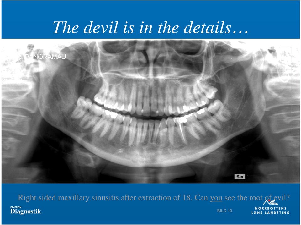 after extraction of 18.