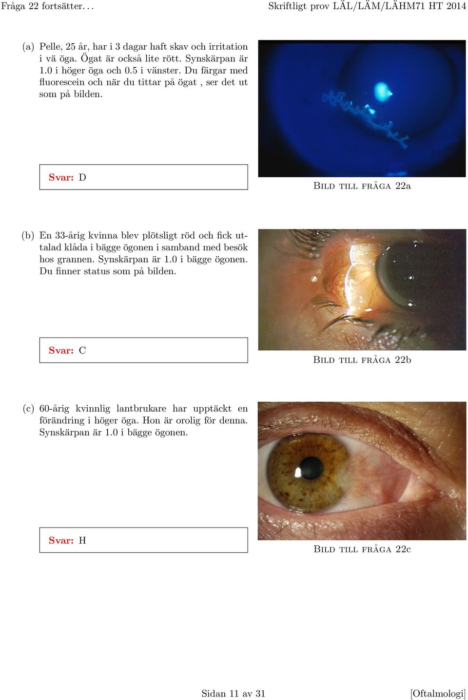 Svar: D Bild till fra ga 22a (b) En 33-a rig kvinna blev plo tsligt ro d och fick uttalad kla da i ba gge o gonen i samband med beso k hos grannen. Synska rpan a r 1.0 i ba gge o gonen.