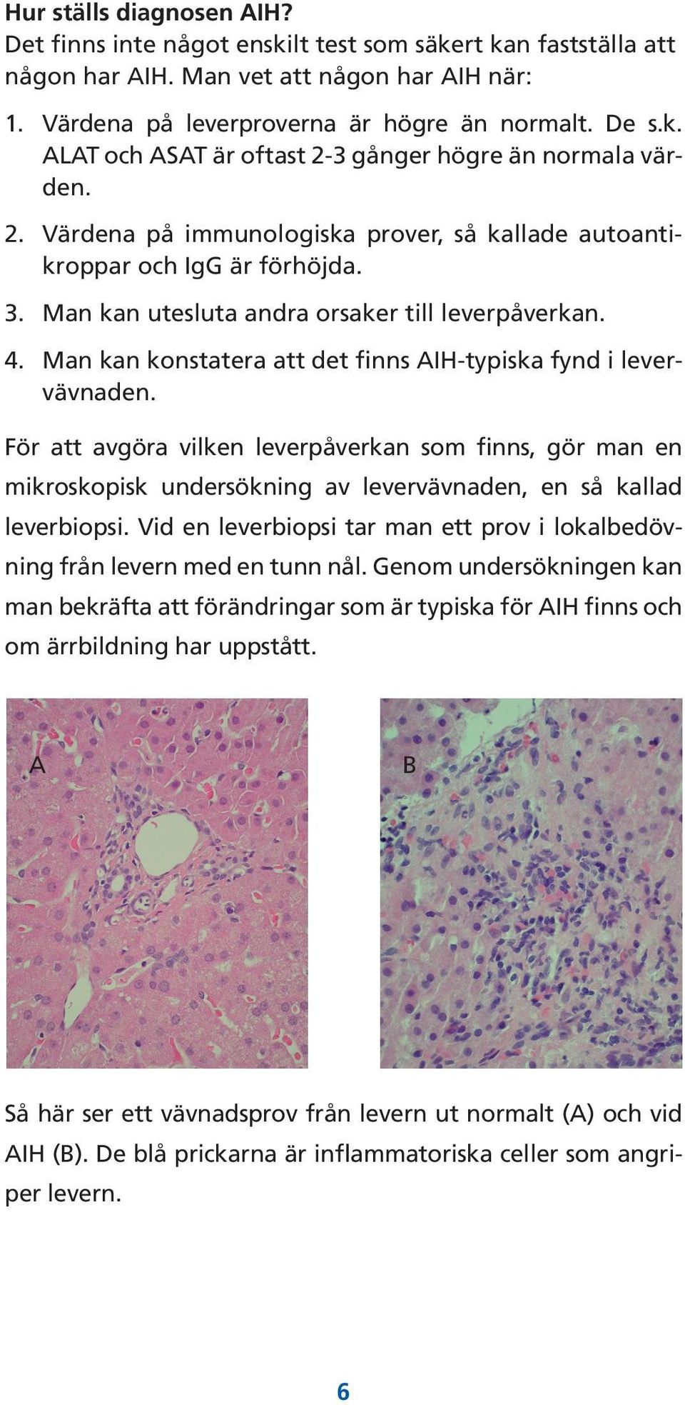 Man kan konstatera att det finns AIH-typiska fynd i levervävnaden. För att avgöra vilken leverpåverkan som finns, gör man en mikroskopisk undersökning av levervävnaden, en så kallad leverbiopsi.