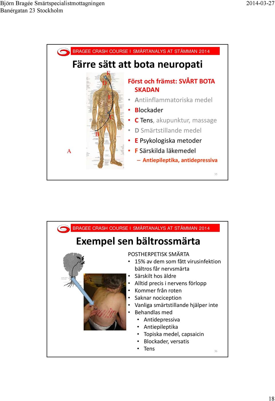 SMÄRTA 15% av dem som fått virusinfektion bältros får nervsmärta Särskilt hos äldre Alltid precis i nervens förlopp Kommer från roten Saknar