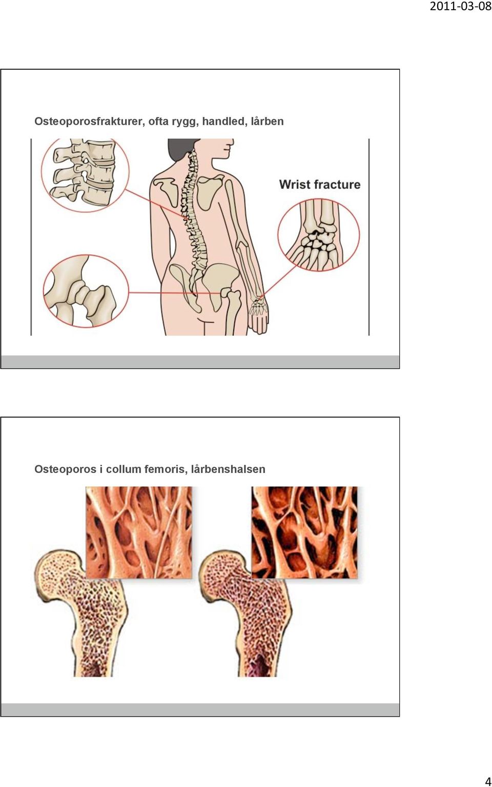lårben Osteoporos i