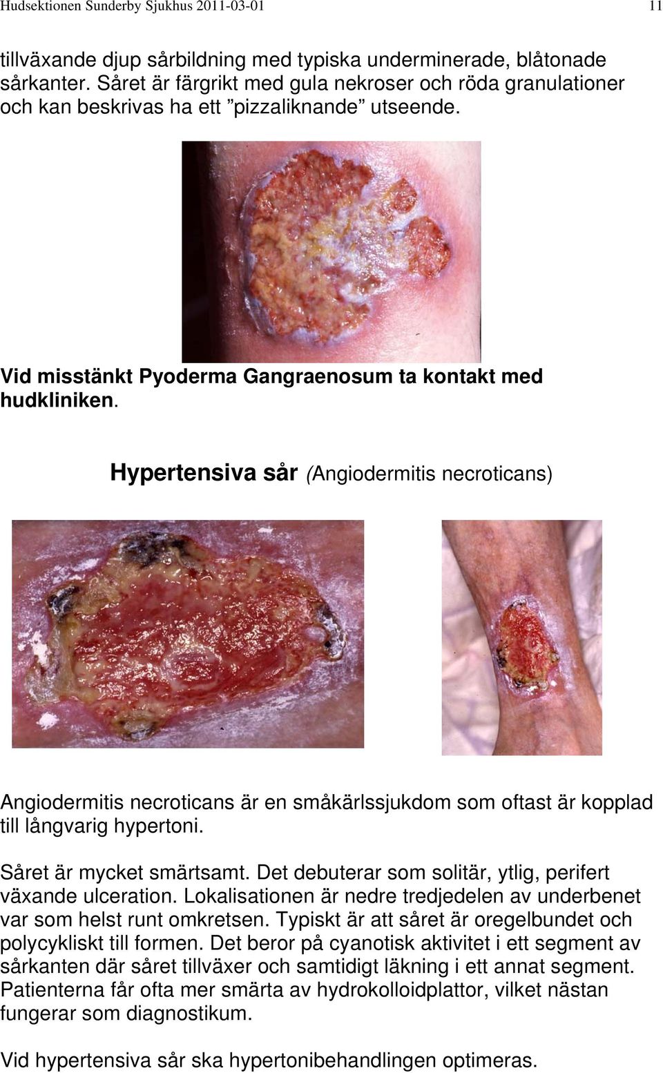 Hypertensiva sår (Angiodermitis necroticans) Angiodermitis necroticans är en småkärlssjukdom som oftast är kopplad till långvarig hypertoni. Såret är mycket smärtsamt.