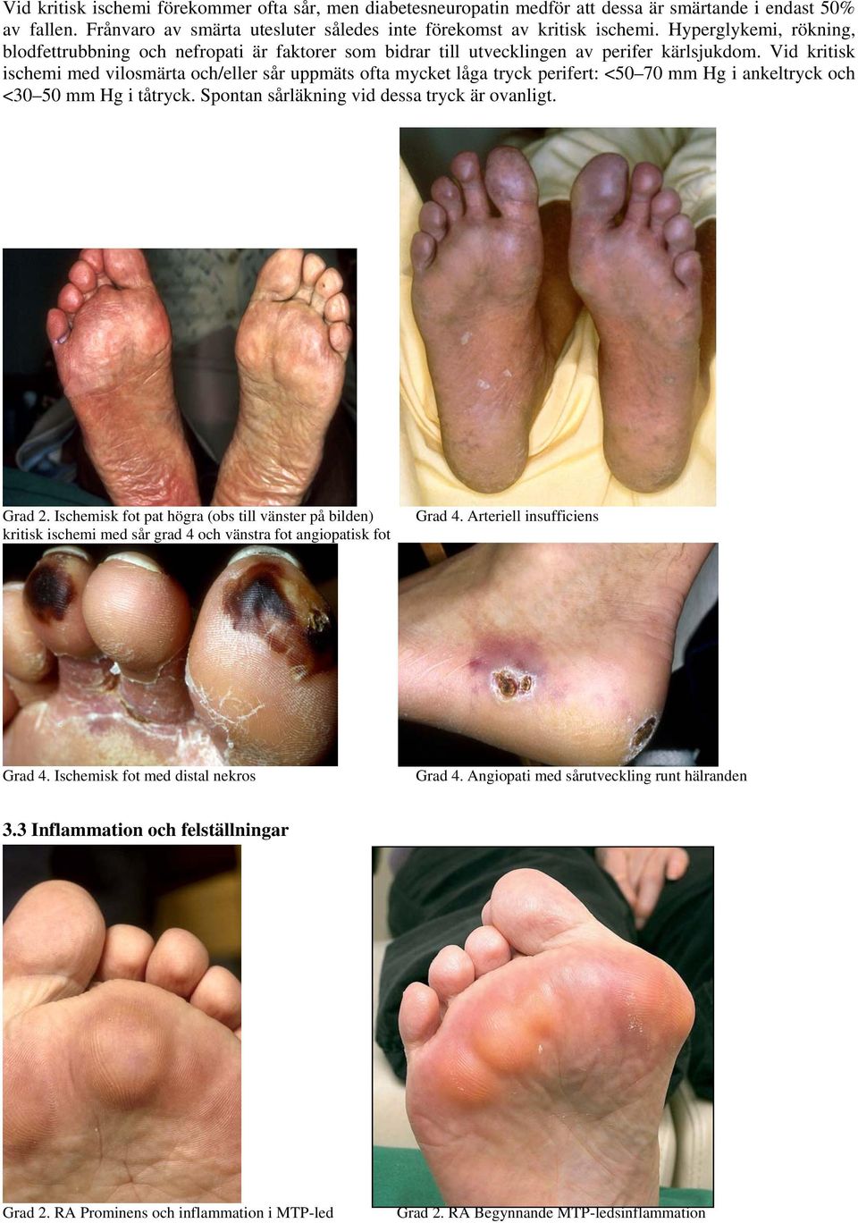 Vid kritisk ischemi med vilosmärta och/eller sår uppmäts ofta mycket låga tryck perifert: <50 70 mm Hg i ankeltryck och <30 50 mm Hg i tåtryck. Spontan sårläkning vid dessa tryck är ovanligt. Grad 2.