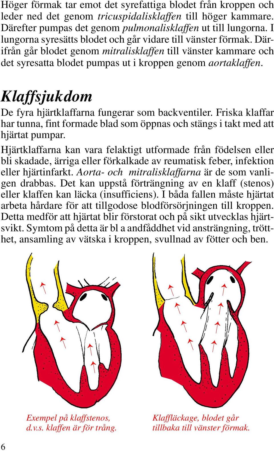 Klaffsjukdom De fyra hjärtklaffarna fungerar som backventiler. Friska klaffar har tunna, fint formade blad som öppnas och stängs i takt med att hjärtat pumpar.