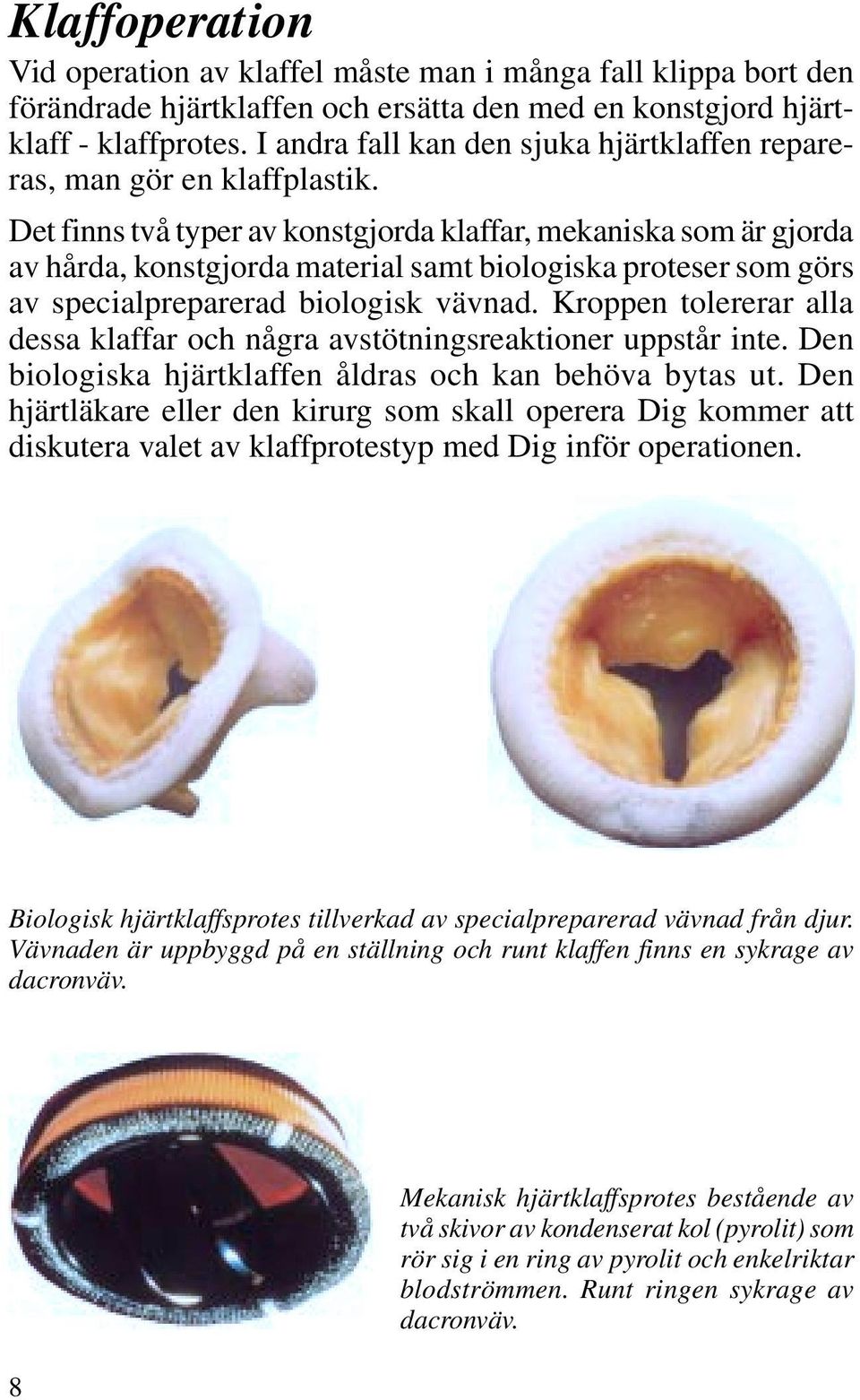 Det finns två typer av konstgjorda klaffar, mekaniska som är gjorda av hårda, konstgjorda material samt biologiska proteser som görs av specialpreparerad biologisk vävnad.