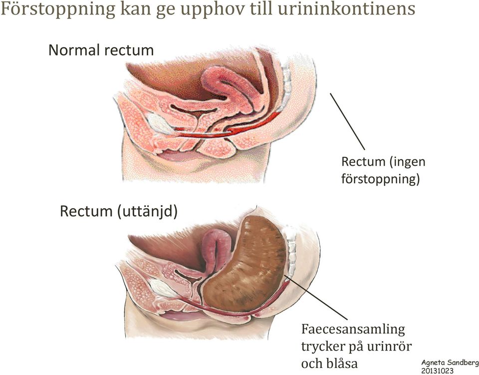 (uttänjd) Rectum (ingen förstoppning)