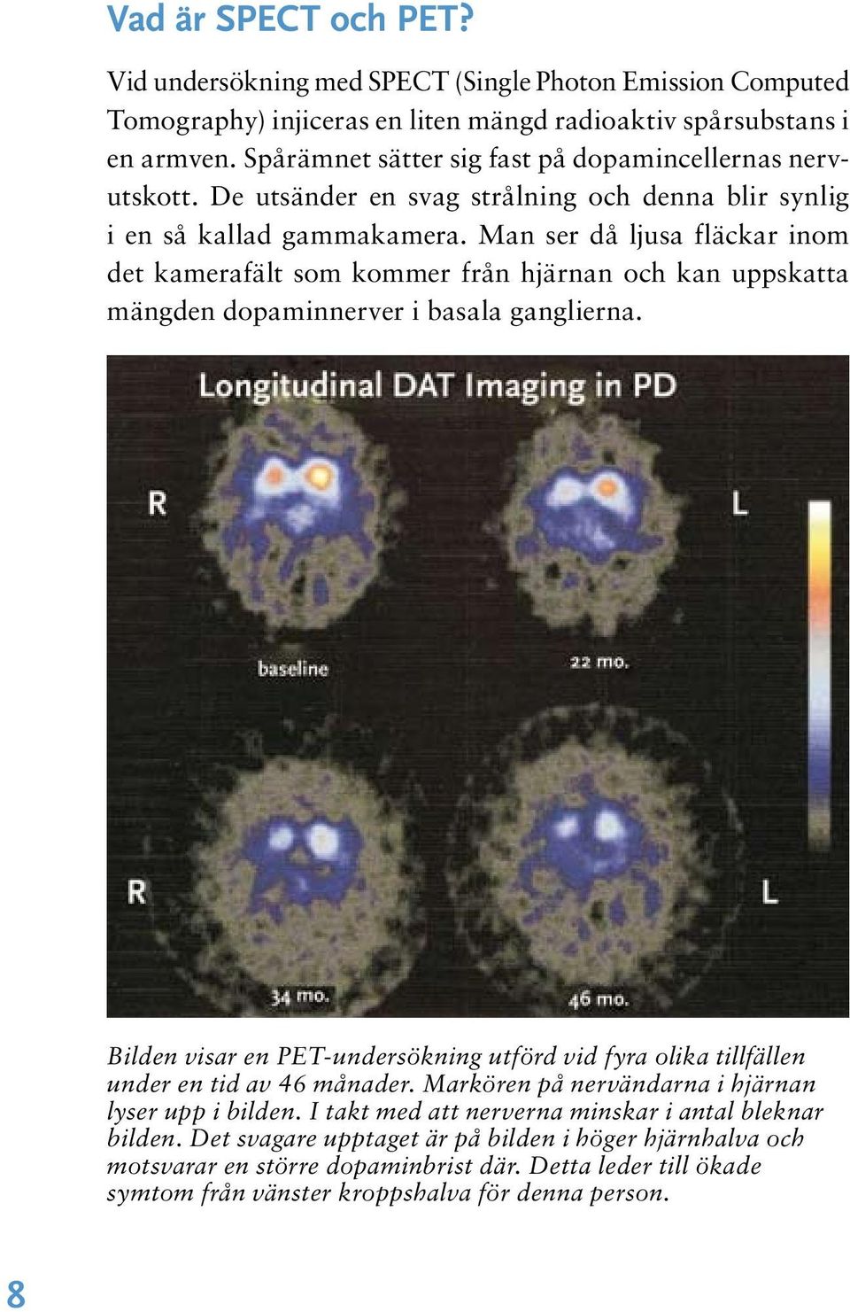 Man ser då ljusa fläckar inom det kamerafält som kommer från hjärnan och kan uppskatta mängden dopaminnerver i basala ganglierna.