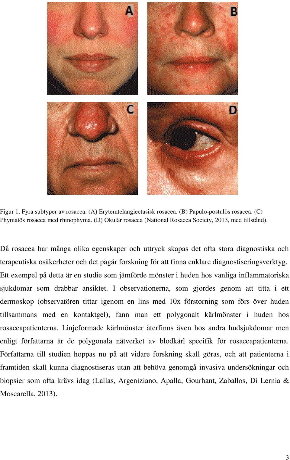 Då rosacea har många olika egenskaper och uttryck skapas det ofta stora diagnostiska och terapeutiska osäkerheter och det pågår forskning för att finna enklare diagnostiseringsverktyg.