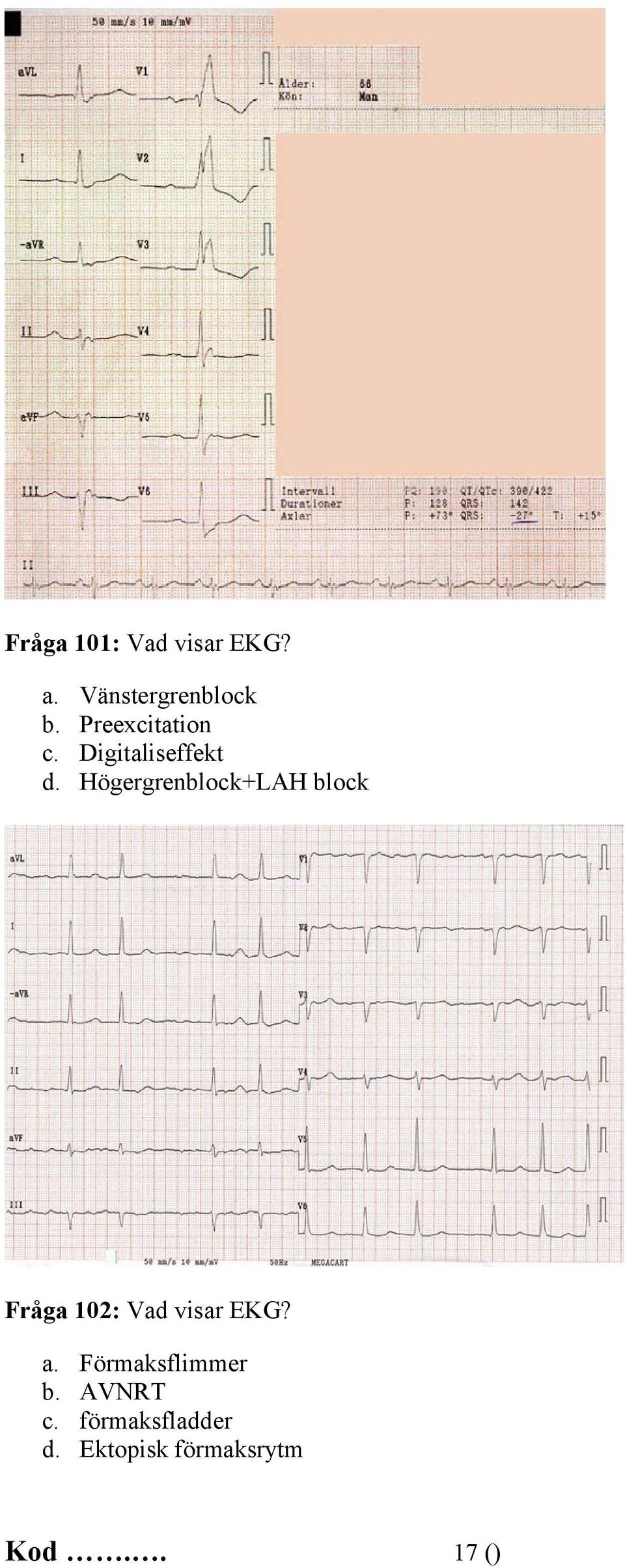 Högergrenblock+LAH block Fråga 102: Vad visar EKG? a.