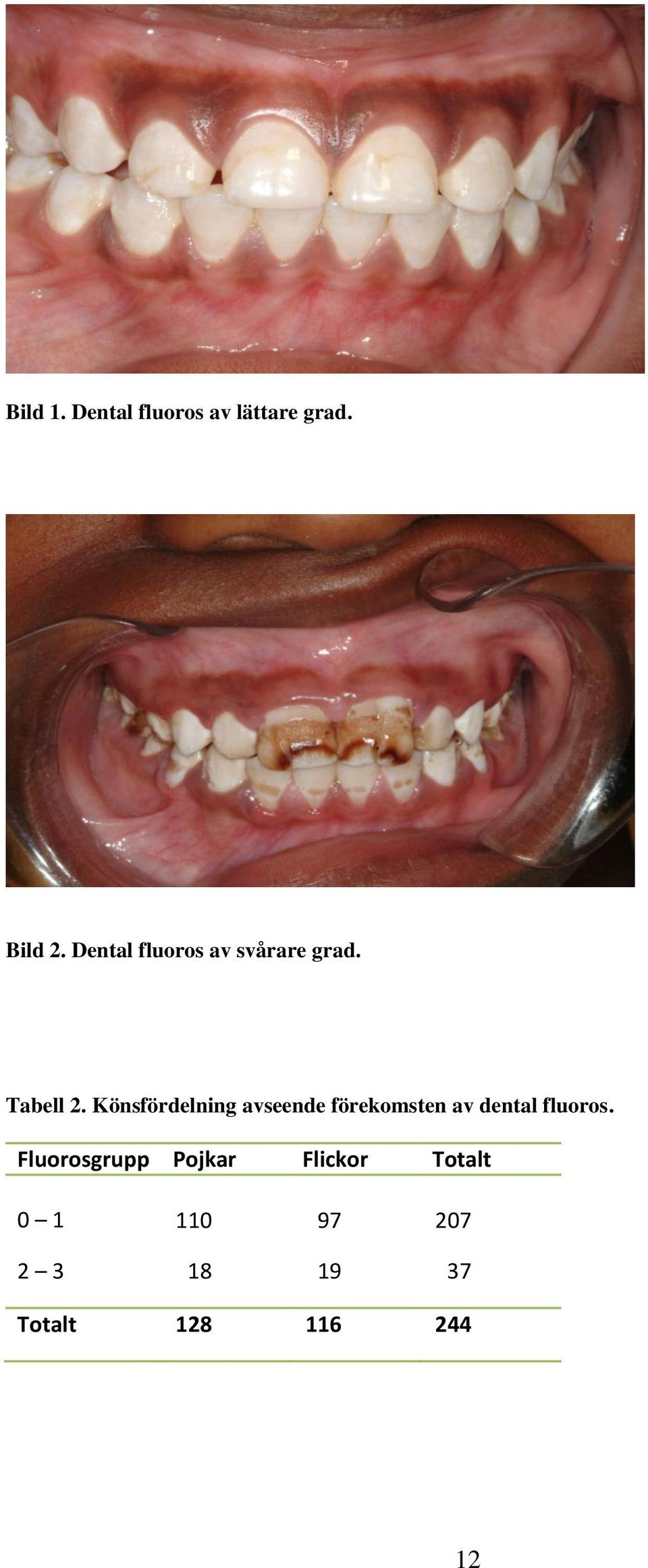 Könsfördelning avseende förekomsten av dental fluoros.