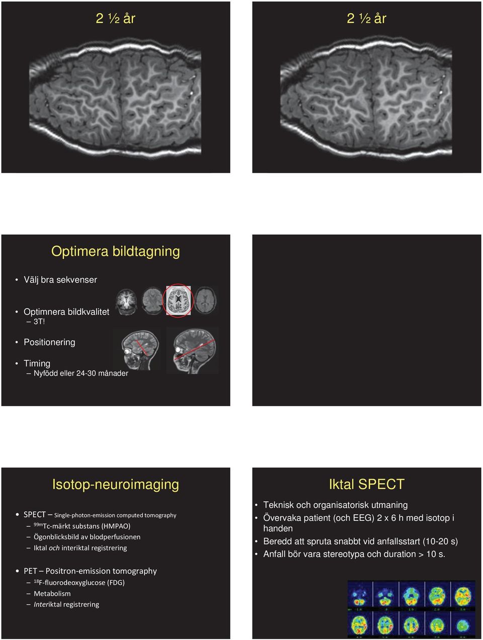 Ögonblicksbild av blodperfusionen Iktal och interiktal registrering PET Positron emission tomography 18 F fluorodeoxyglucose (FDG) Metabolism