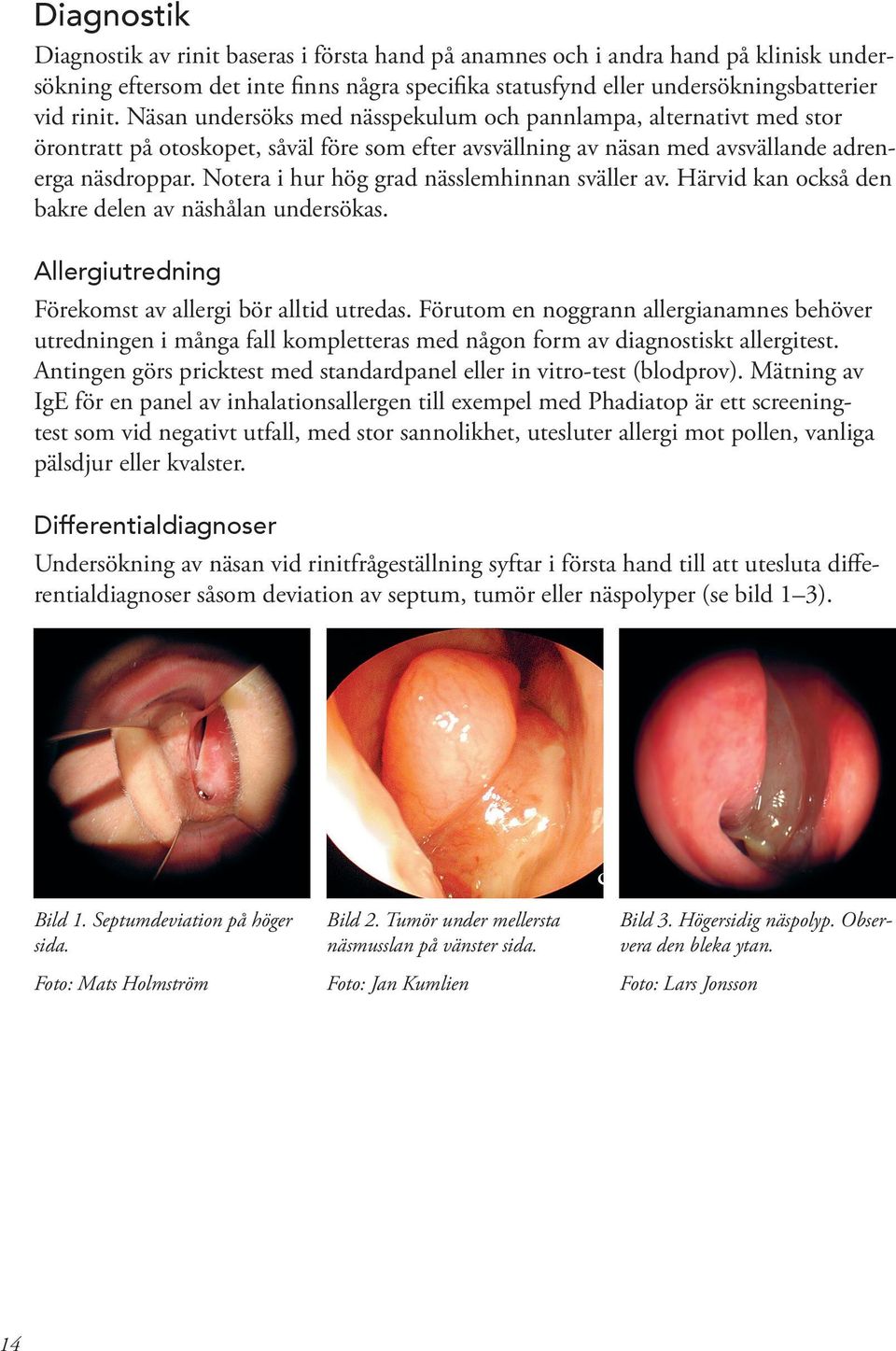 Notera i hur hög grad nässlemhinnan sväller av. Härvid kan också den bakre delen av näshålan undersökas. Allergiutredning Förekomst av allergi bör alltid utredas.