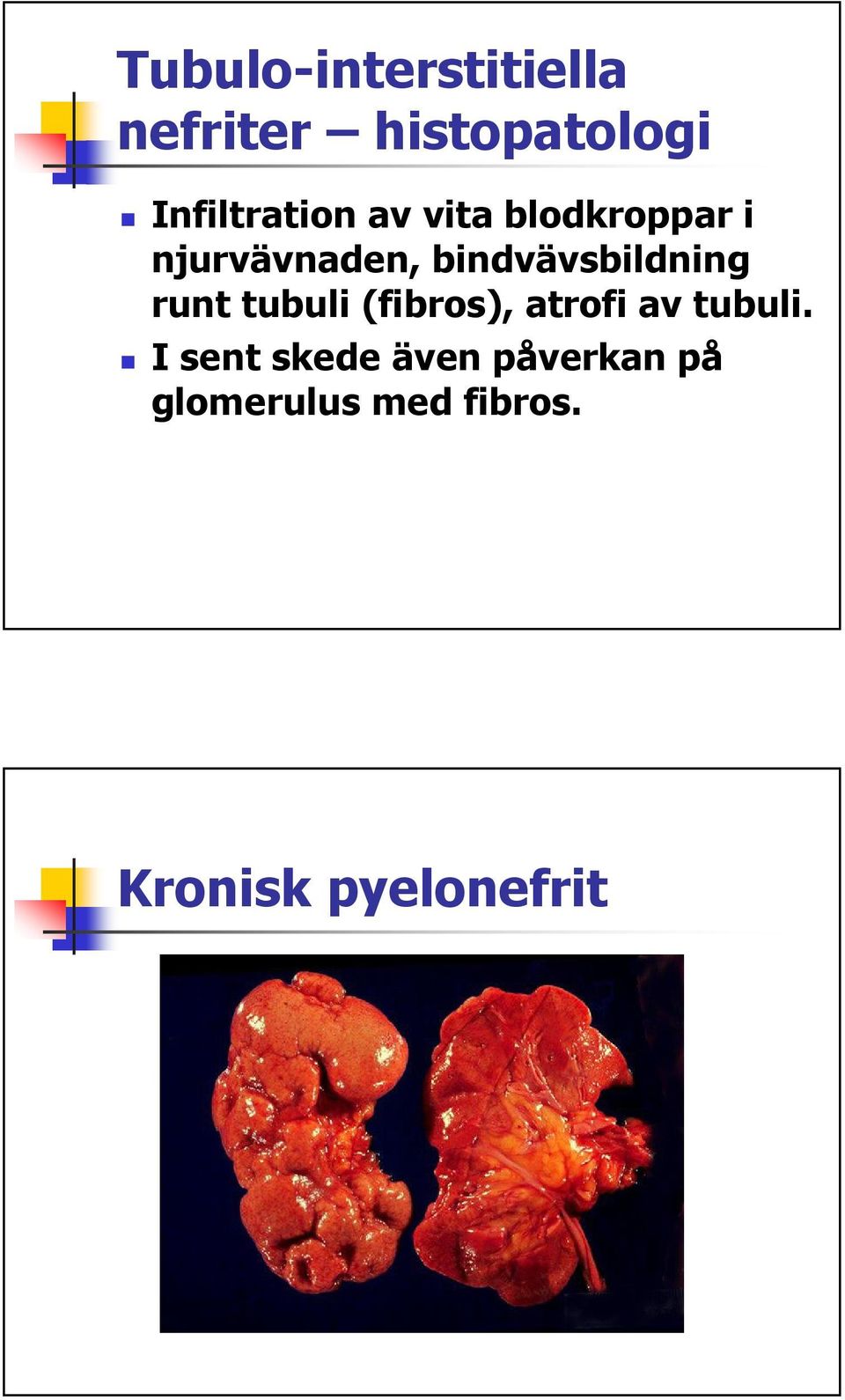 bindvävsbildning runt tubuli (fibros), atrofi av tubuli.