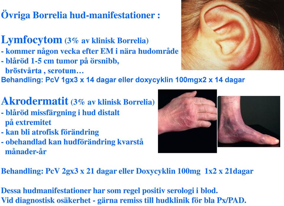 missfärgning i hud distalt på extremitet - kan bli atrofisk förändring - obehandlad kan hudförändring kvarstå månader-år Behandling: PcV 2gx3 x 21 dagar