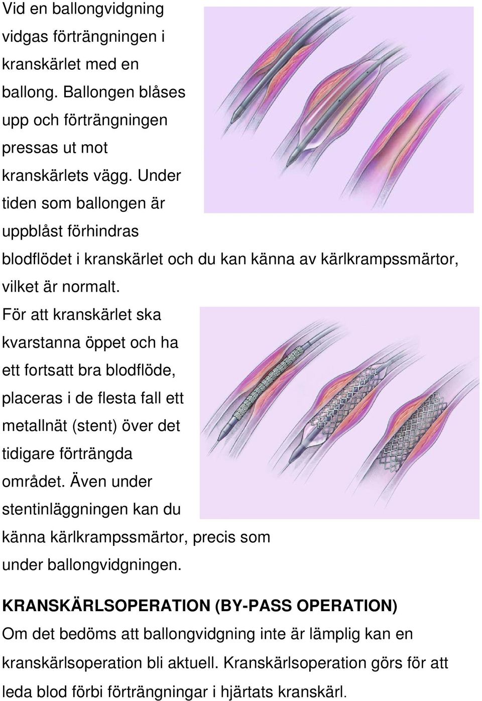 För att kranskärlet ska kvarstanna öppet och ha ett fortsatt bra blodflöde, placeras i de flesta fall ett metallnät (stent) över det tidigare förträngda området.