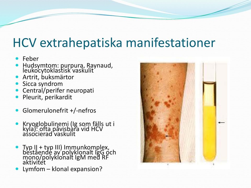 +/-nefros Kryoglobulinemi (Ig som fälls ut i kyla): ofta påvisbara vid HCV associerad vaskulit Typ II +