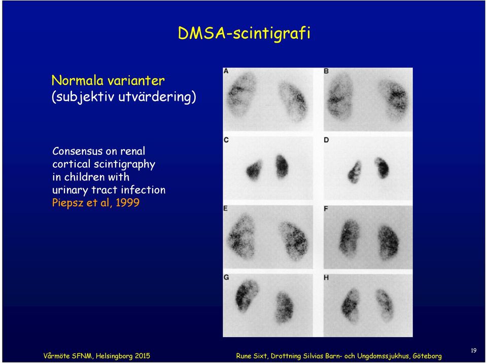 renal cortical scintigraphy in children