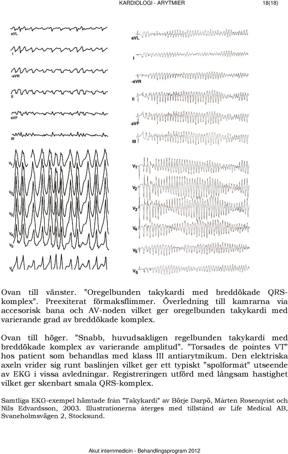 Snabb, huvudsakligen regelbunden takykardi med breddökade komplex av varierande amplitud. Torsades de pointes VT hos patient som behandlas med klass III antiarytmikum.