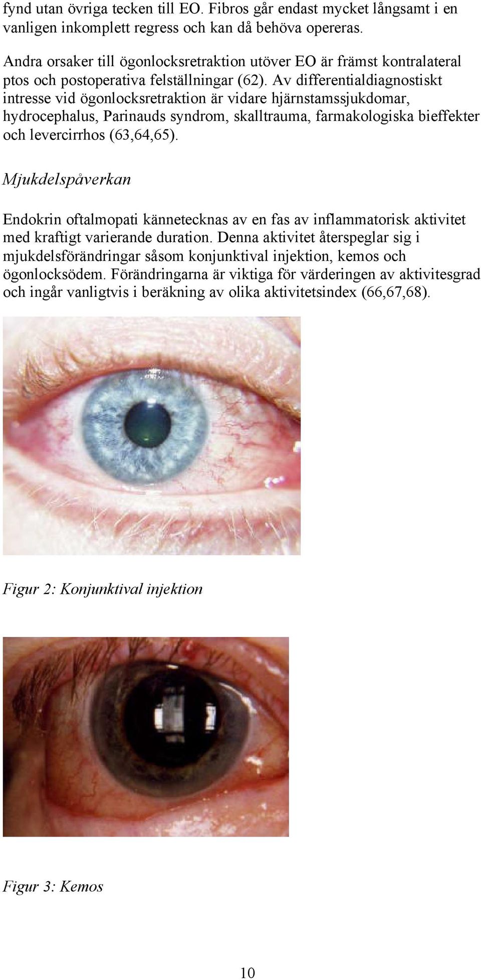 Av differentialdiagnostiskt intresse vid ögonlocksretraktion är vidare hjärnstamssjukdomar, hydrocephalus, Parinauds syndrom, skalltrauma, farmakologiska bieffekter och levercirrhos (63,64,65).