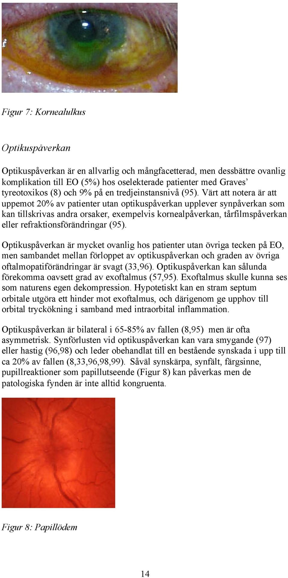 Värt att notera är att uppemot 20% av patienter utan optikuspåverkan upplever synpåverkan som kan tillskrivas andra orsaker, exempelvis kornealpåverkan, tårfilmspåverkan eller refraktionsförändringar