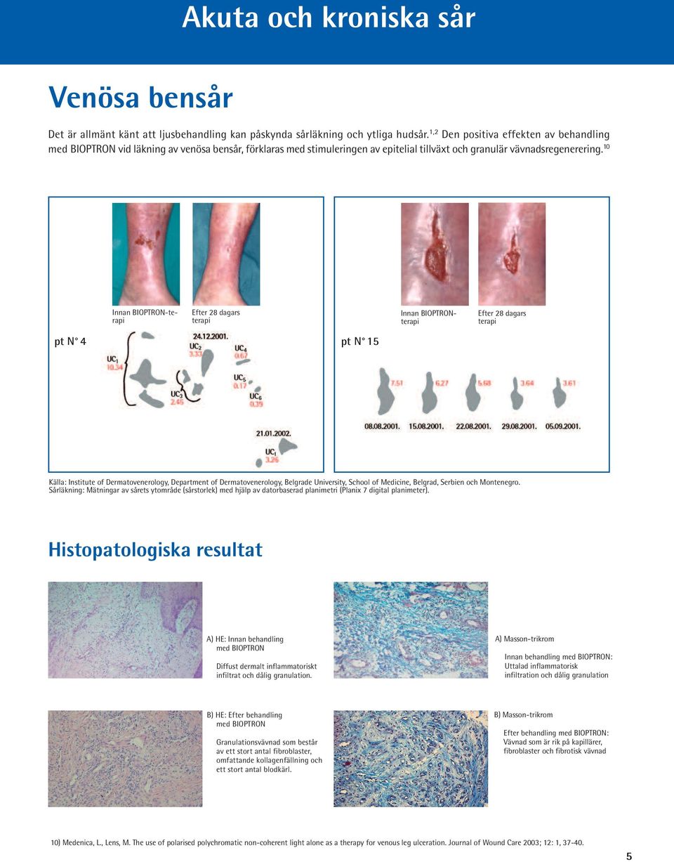 10 Innan BIOPTRON-terapi Efter 28 dagars terapi Innan BIOPTRONterapi Efter 28 dagars terapi pt N 4 pt N 15 Källa: Institute of Dermatovenerology, Department of Dermatovenerology, Belgrade University,