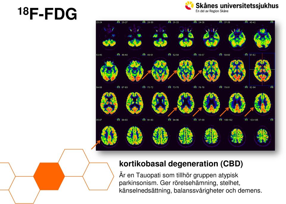 parkinsonism.