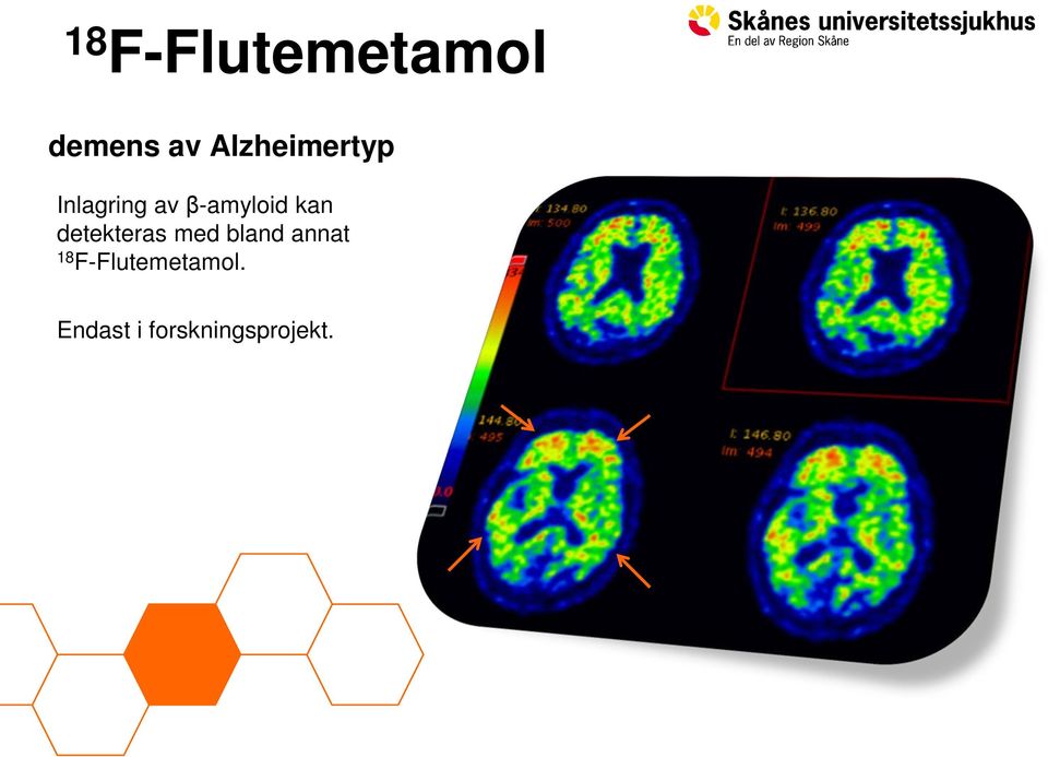 β-amyloid kan detekteras med bland