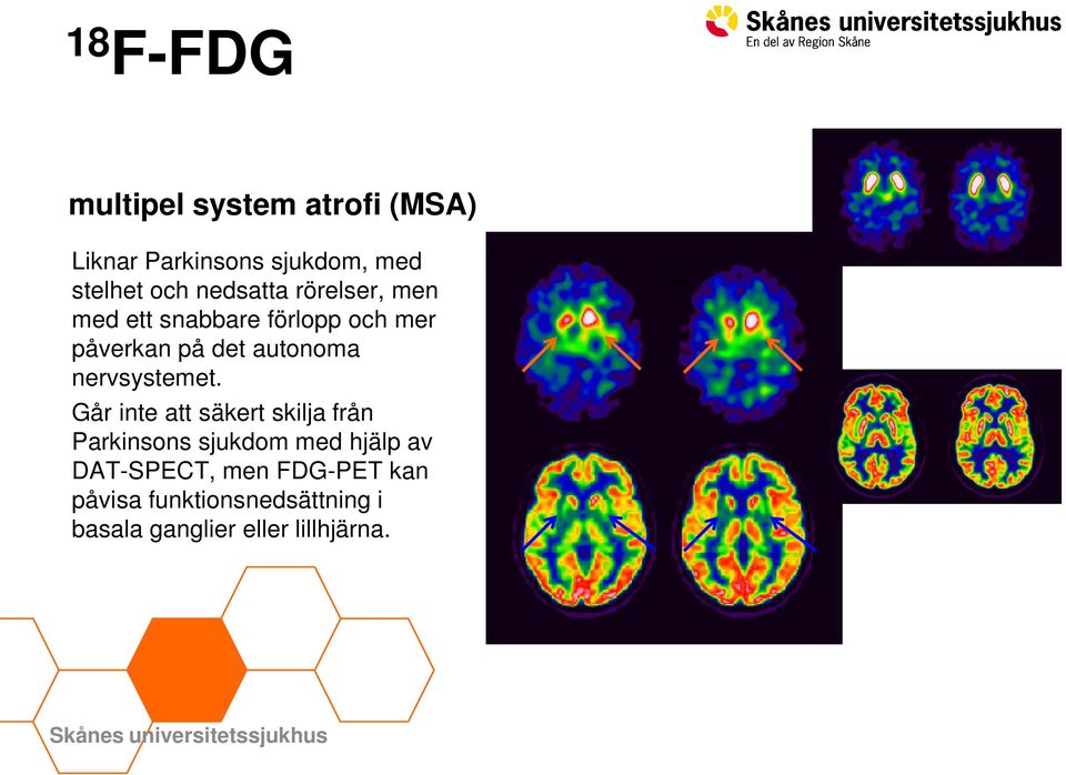 Går inte att säkert skilja från Parkinsons sjukdom med hjälp av DAT-SPECT, men FDG-PET