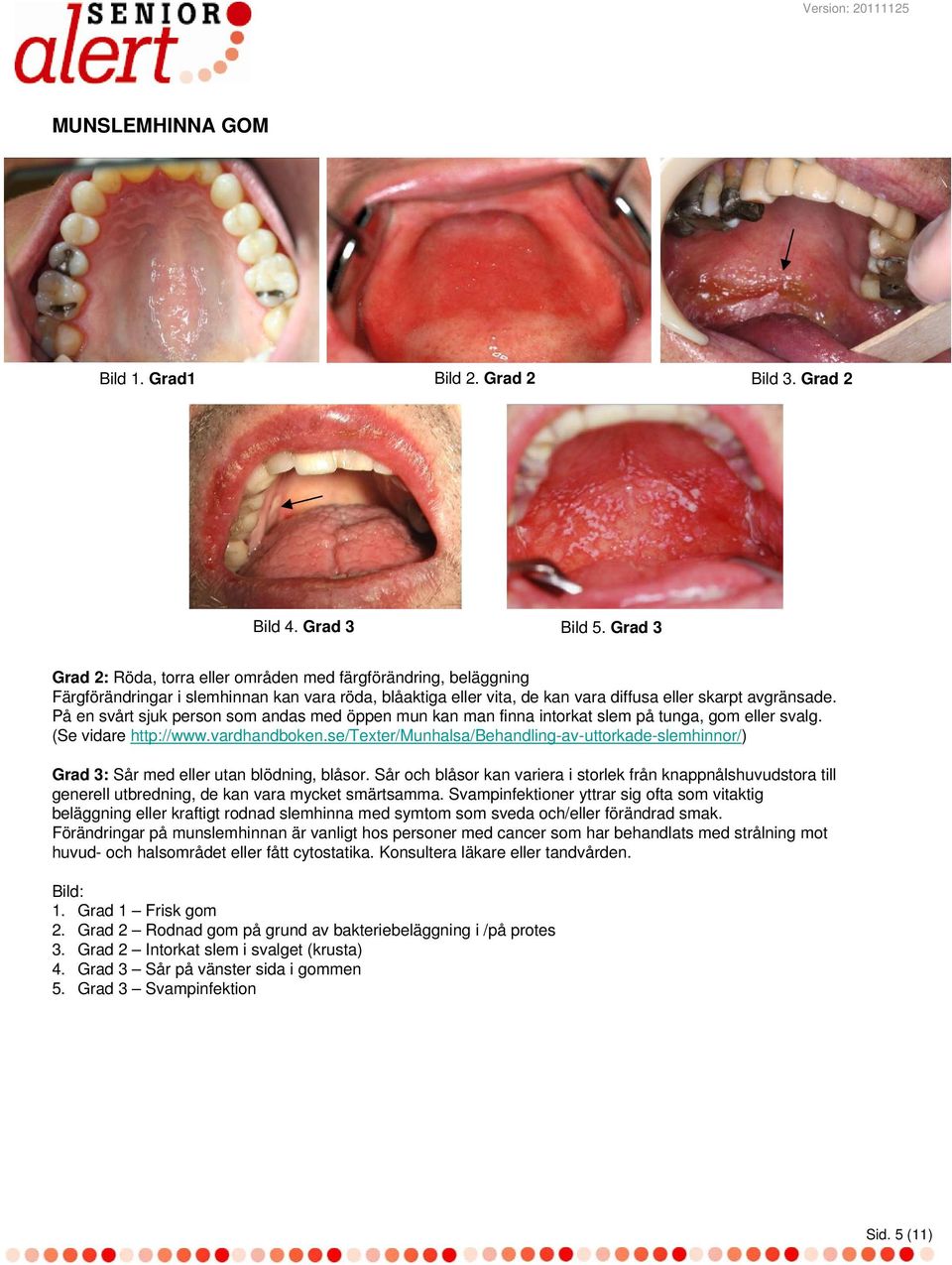 På en svårt sjuk person som andas med öppen mun kan man finna intorkat slem på tunga, gom eller svalg. (Se vidare http://www.vardhandboken.