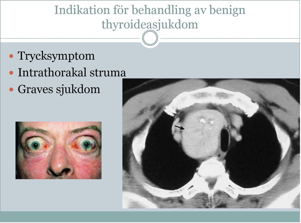 thyroideasjukdom